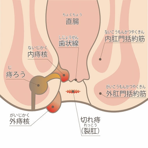 痔の種類