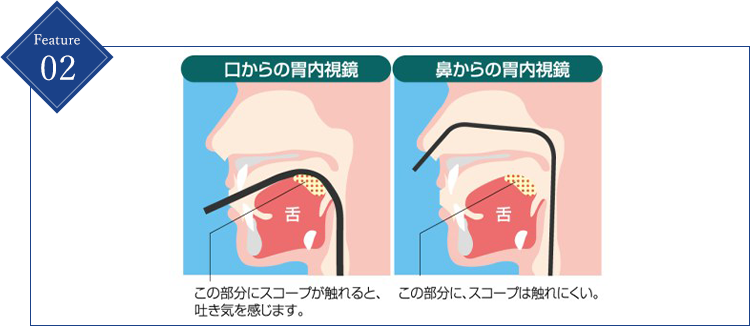 嘔吐反射を抑えて楽に受けられる経鼻内視鏡検査